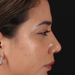 Rhinoplasty Before & After Patient #3082