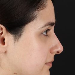 Liquid Rhinoplasty Before & After Patient #2188