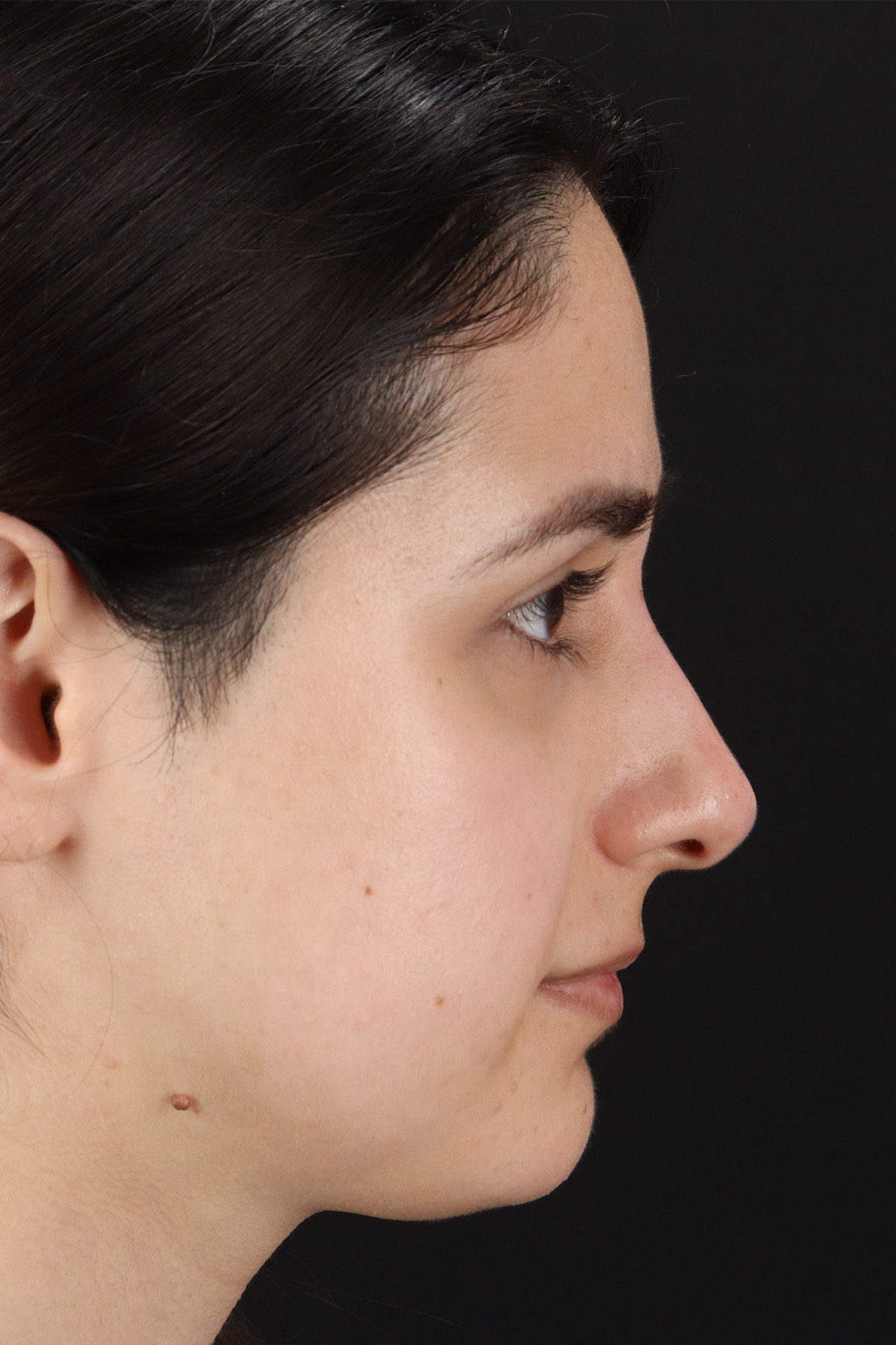 Liquid Rhinoplasty Before & After Patient #2188