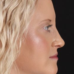 Rhinoplasty Before & After Patient #3126