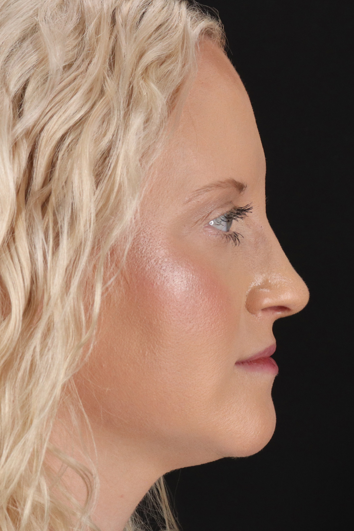 Rhinoplasty Before & After Patient #3126