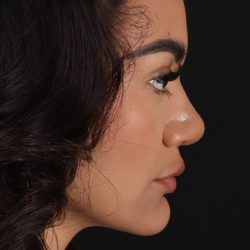 Rhinoplasty Before & After Patient #3192