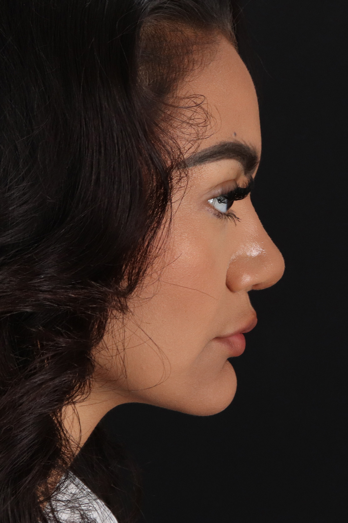 Rhinoplasty Before & After Patient #3192