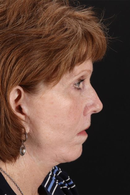 Lip Lift Before & After Patient #2155