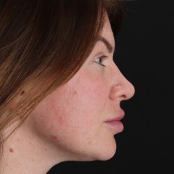 Rhinoplasty Before & After Patient #3093