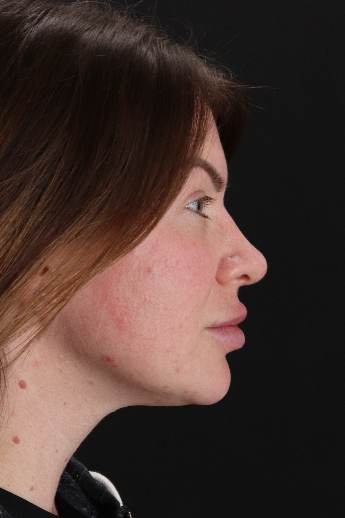 Rhinoplasty Before & After Patient #3093