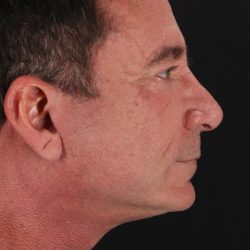 Facelift Before & After Patient #1899