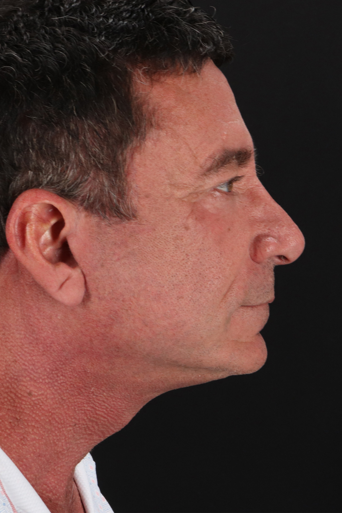 Facelift Before & After Patient #1899