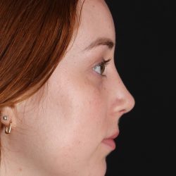 Rhinoplasty Before & After Patient #3170