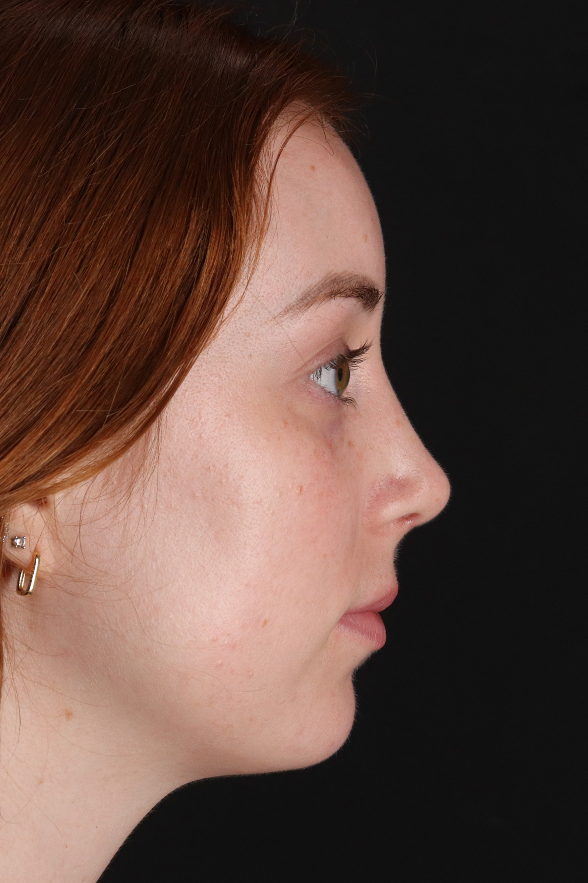 Rhinoplasty Before & After Patient #3170