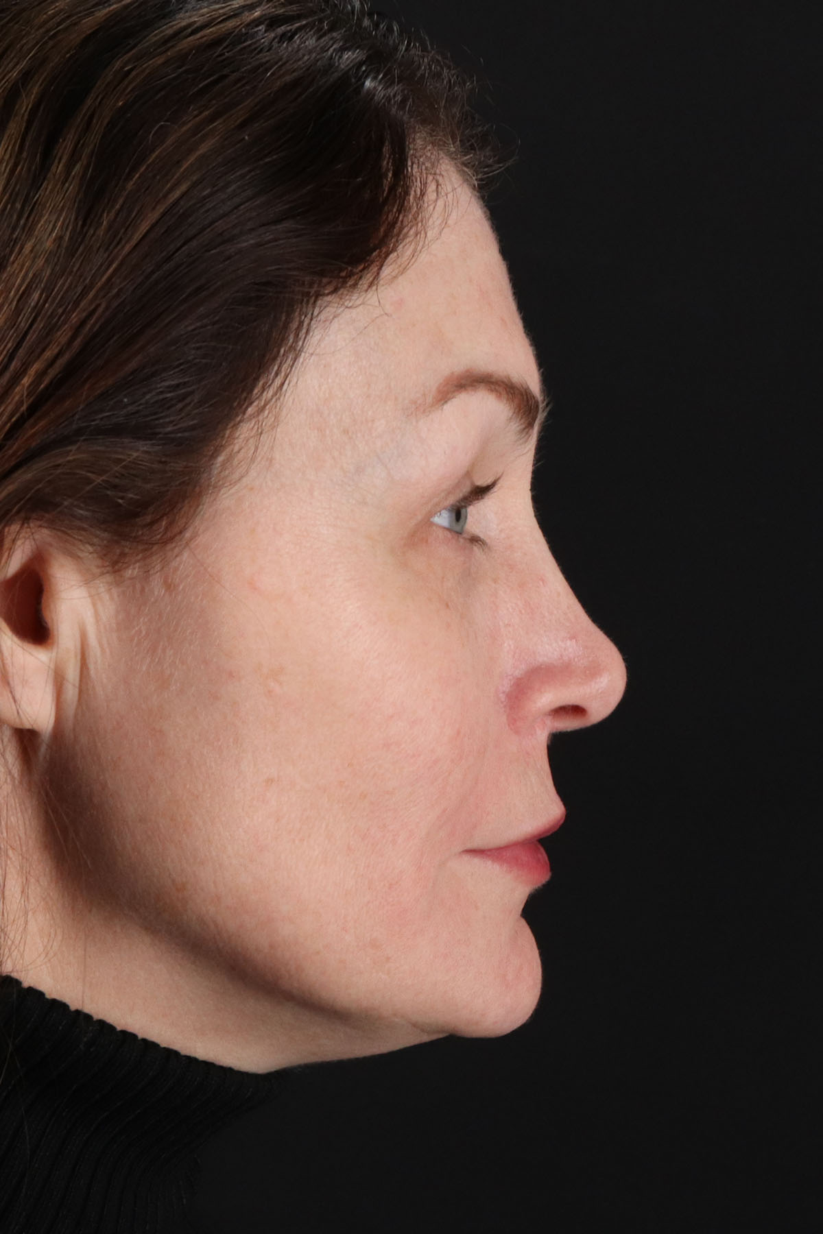 Lip Lift Before & After Patient #2144