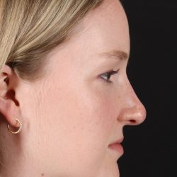 Liquid Rhinoplasty Before & After Patient #2177