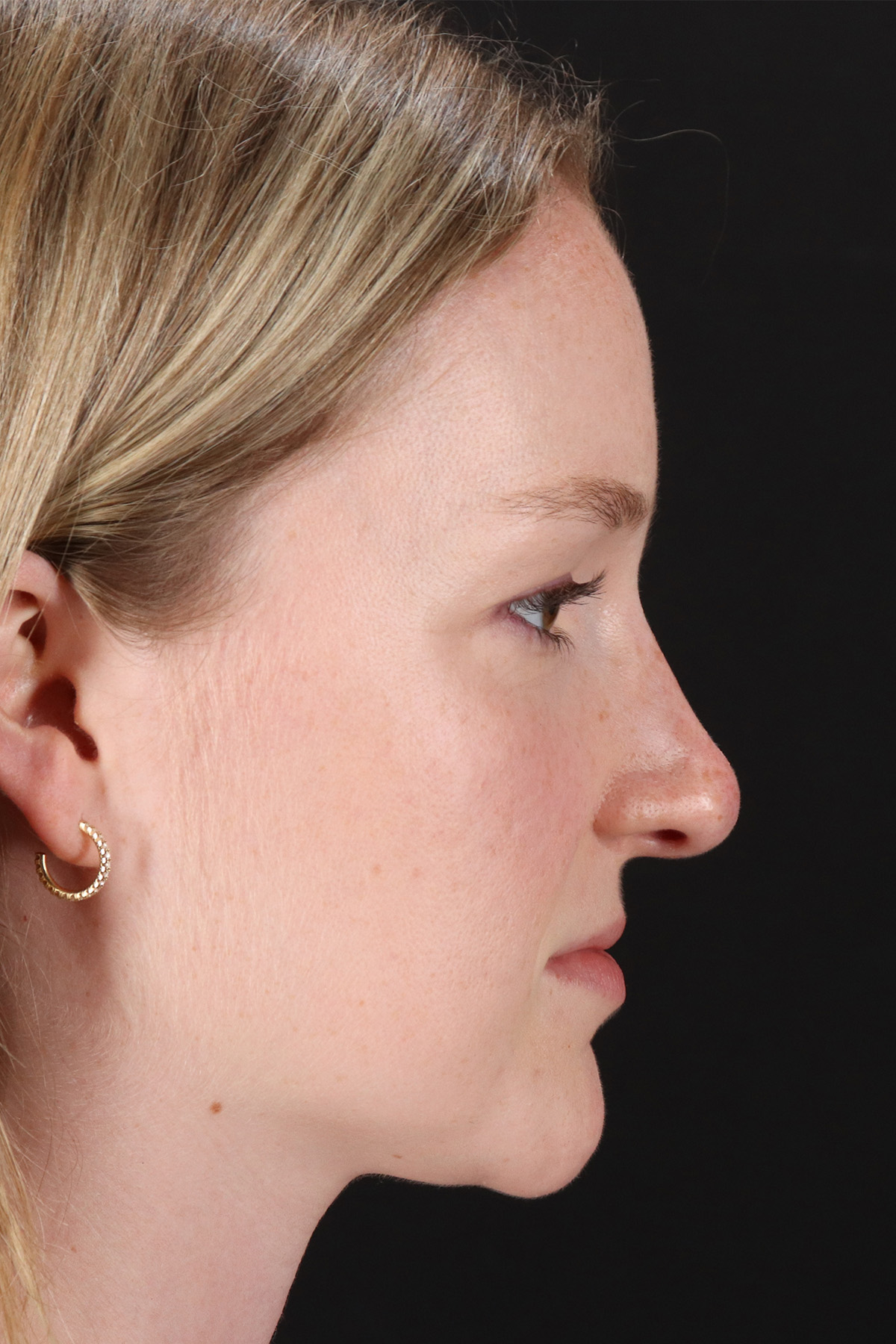 Liquid Rhinoplasty Before & After Patient #2177