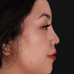 Rhinoplasty Before & After Patient #3060