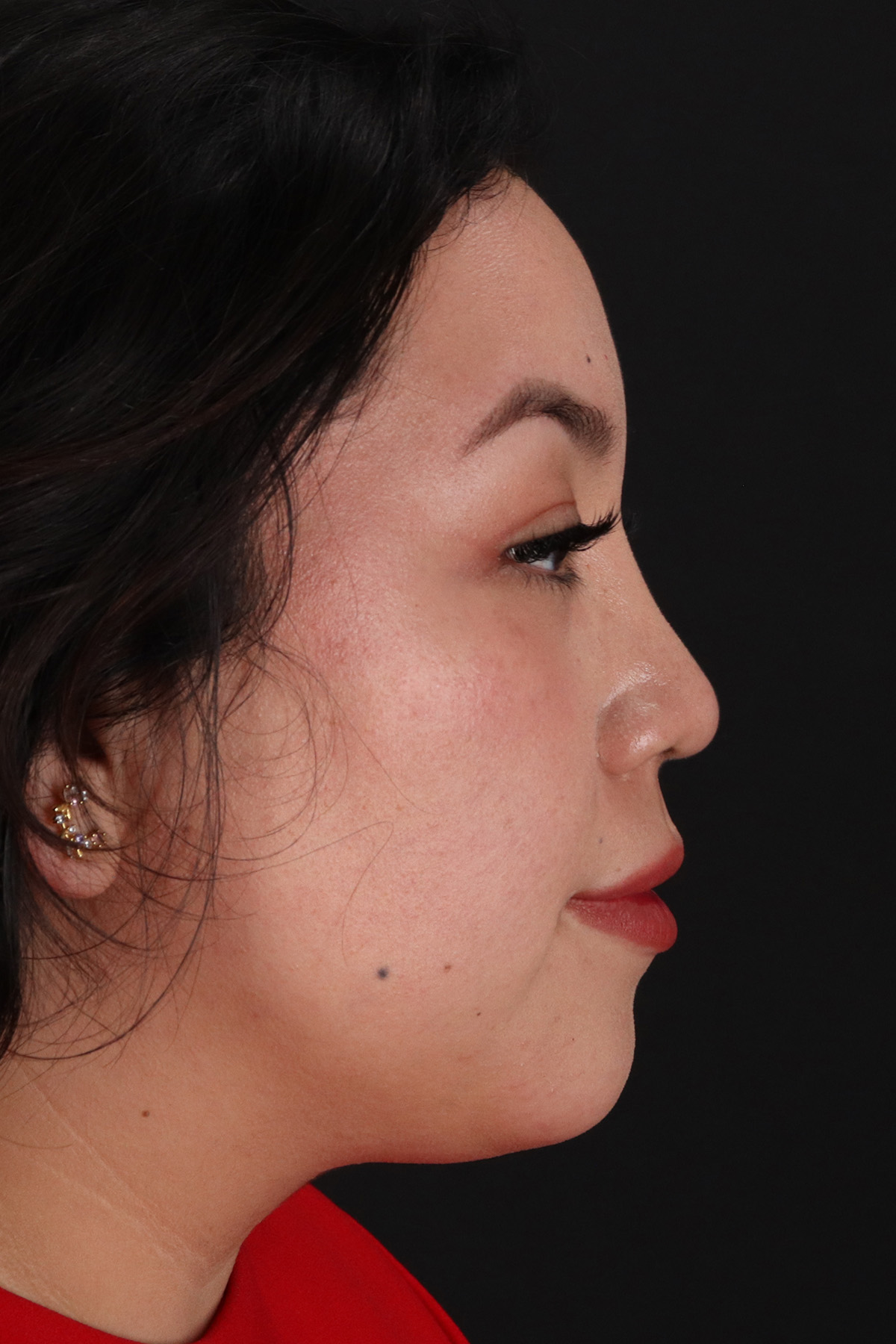 Rhinoplasty Before & After Patient #3060