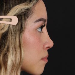 Rhinoplasty Before & After Patient #3302