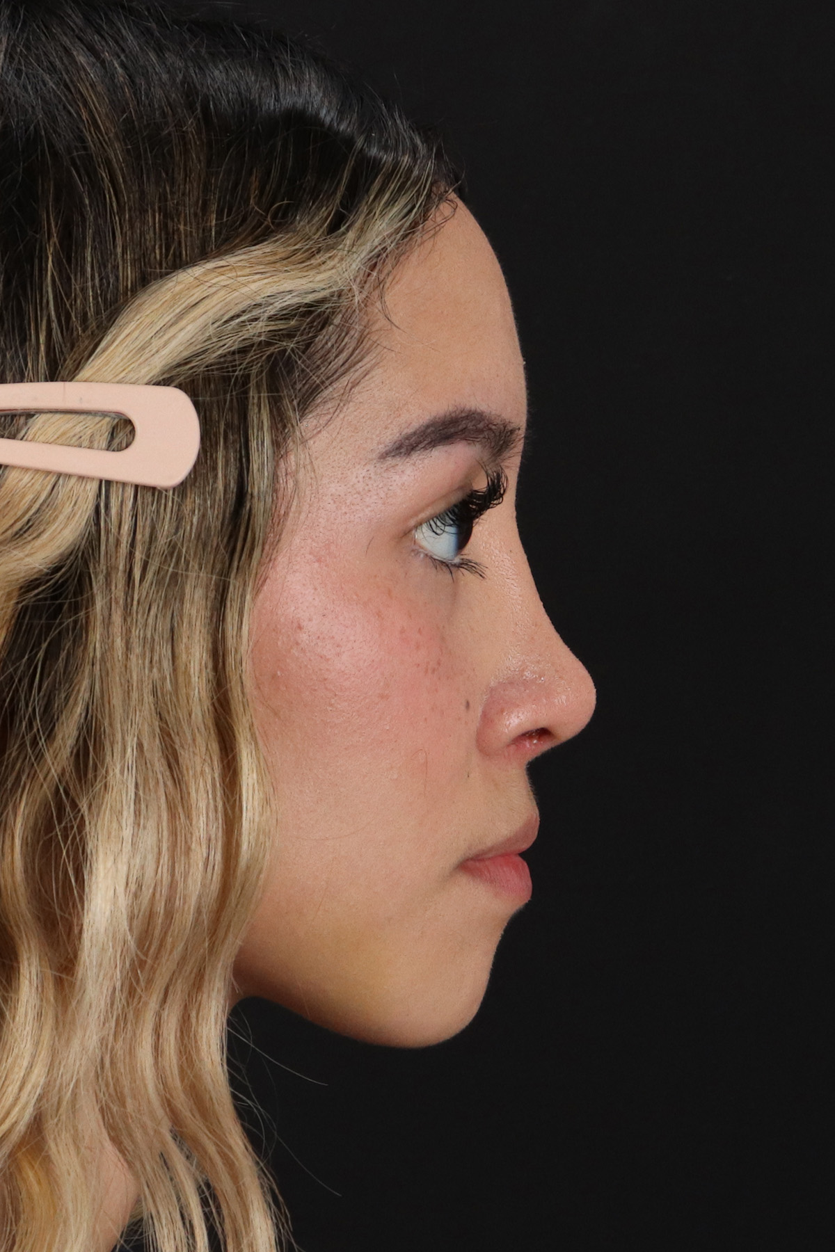 Rhinoplasty Before & After Patient #3302