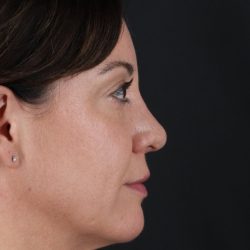 Browlift Before & After Patient #1363