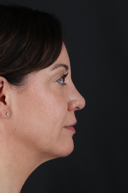 Browlift Before & After Patient #1363