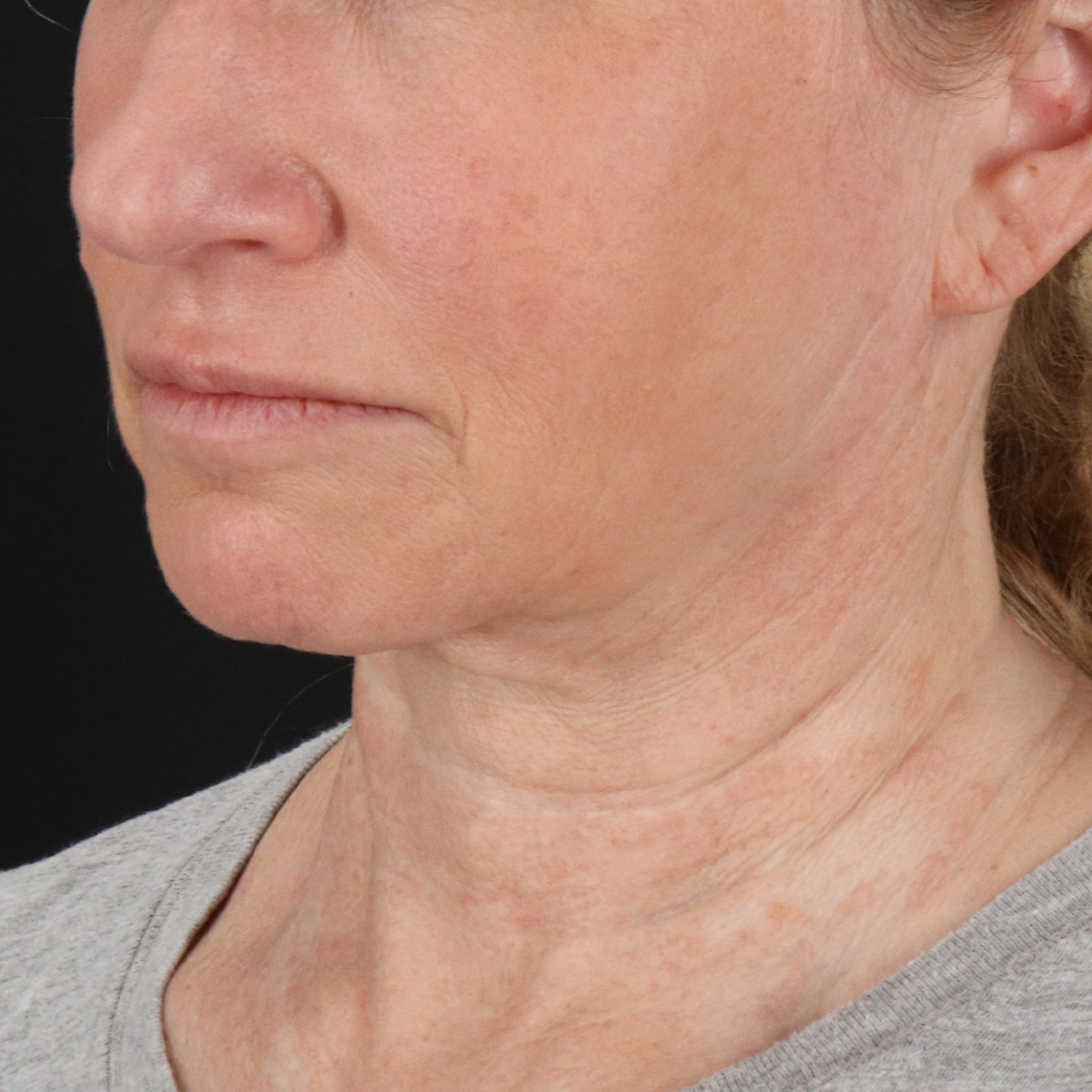 Neck Lift Before & After Patient #2571