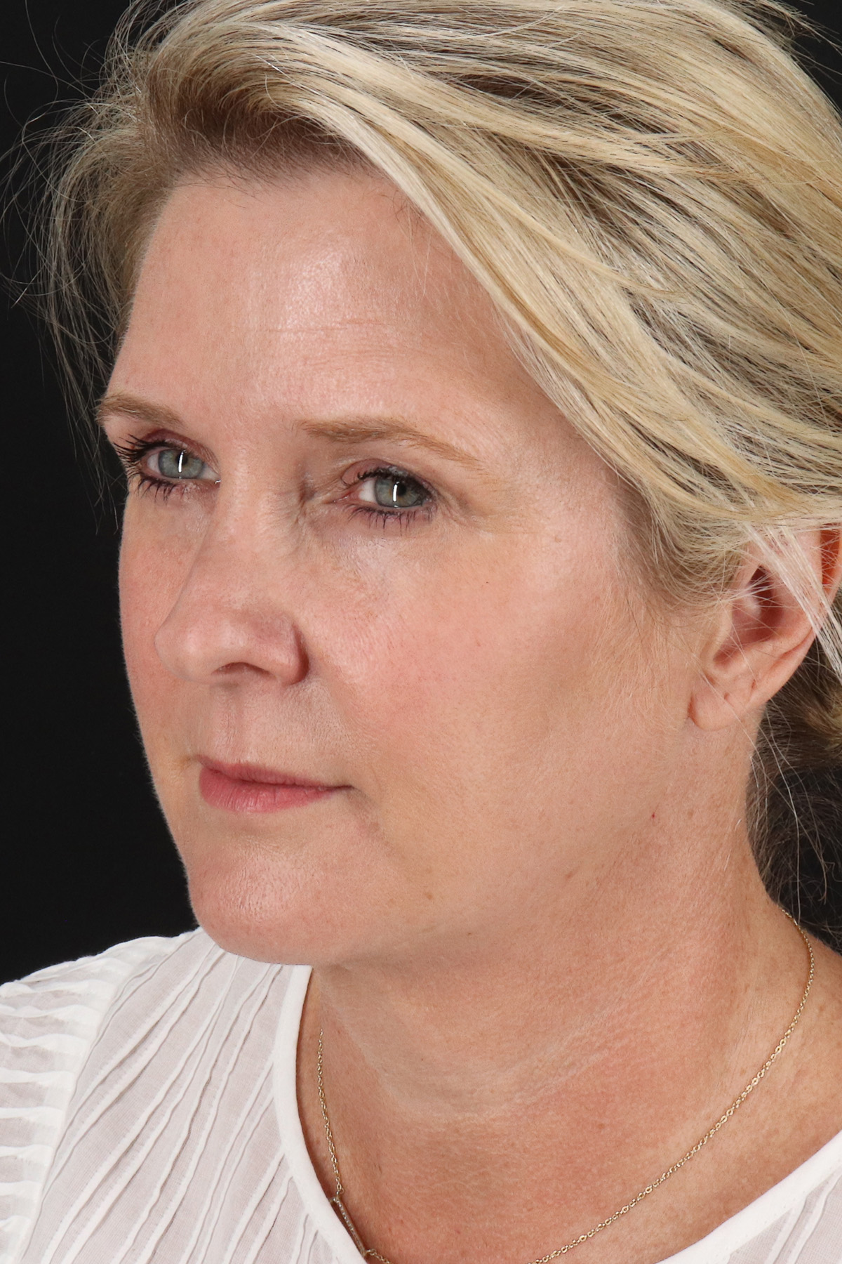 Facelift Before & After Patient #1877
