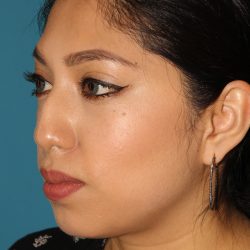 Chin Implant Before & After Patient #1670