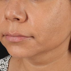Facelift Before & After Patient #3555