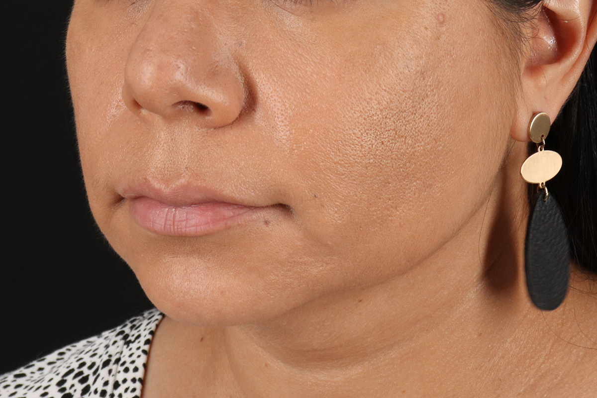 Facelift Before & After Patient #3555