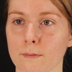 Rhinoplasty Before & After Patient #3280