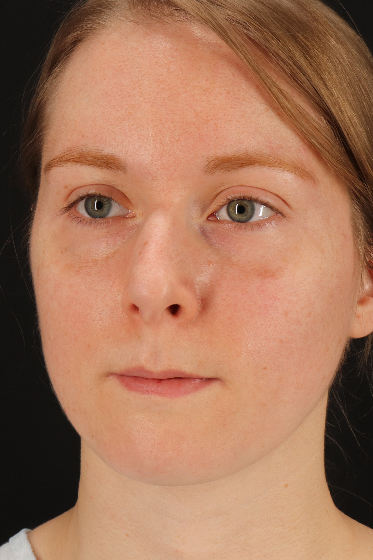 Rhinoplasty Before & After Patient #3280