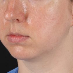 Chin Implant Before & After Patient #1562