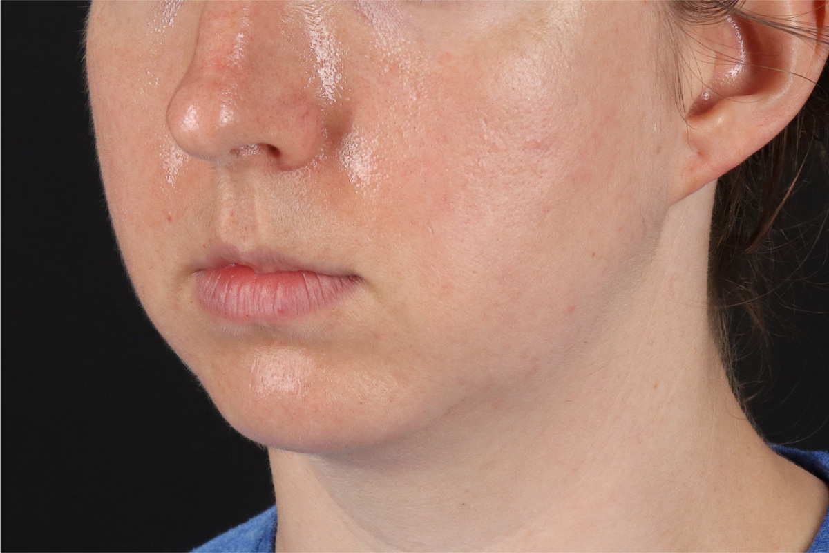 Chin Implant Before & After Patient #1562