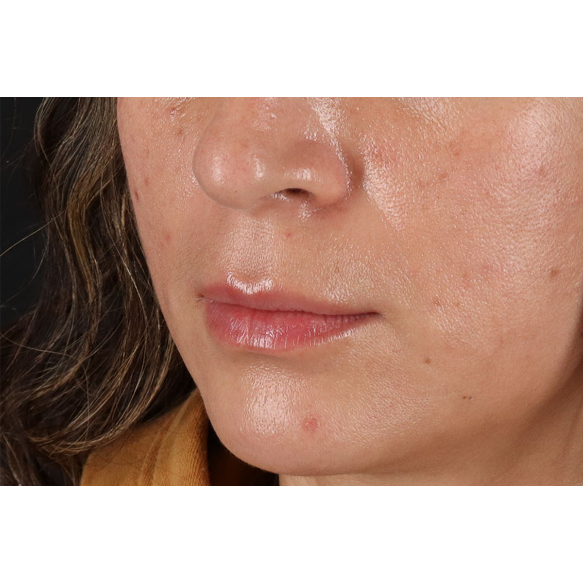 Lip Lift Before & After Patient #2166