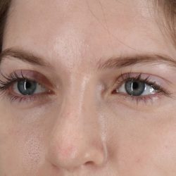 Browlift Before & After Patient #1319