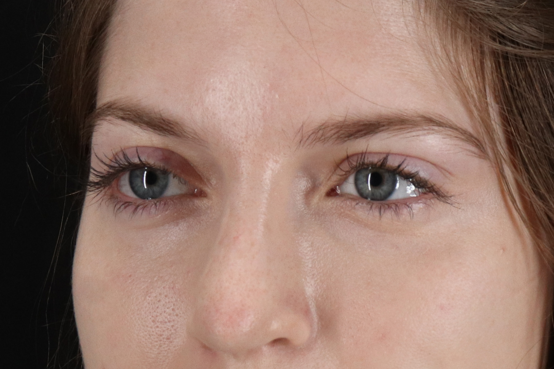 Browlift Before & After Patient #1319
