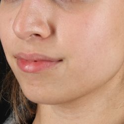 Chin Implant Before & After Patient #1573