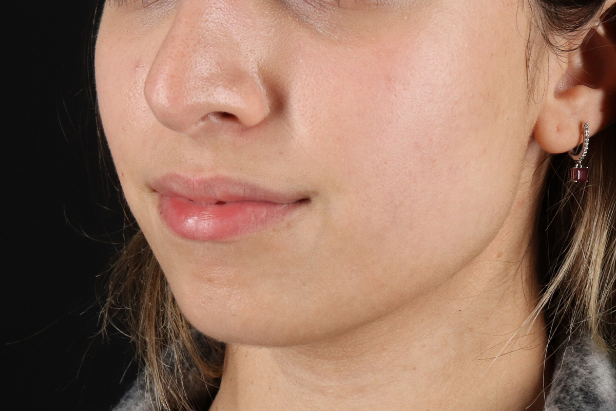 Chin Implant Before & After Patient #1573
