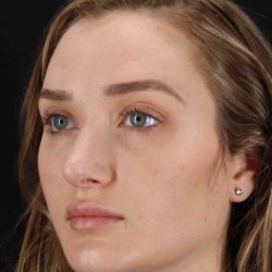 Browlift Before & After Patient #1297