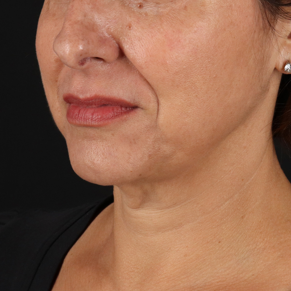 Facelift Before & After Patient #1809