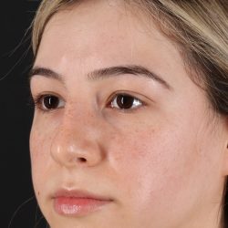 Rhinoplasty Before & After Patient #3247