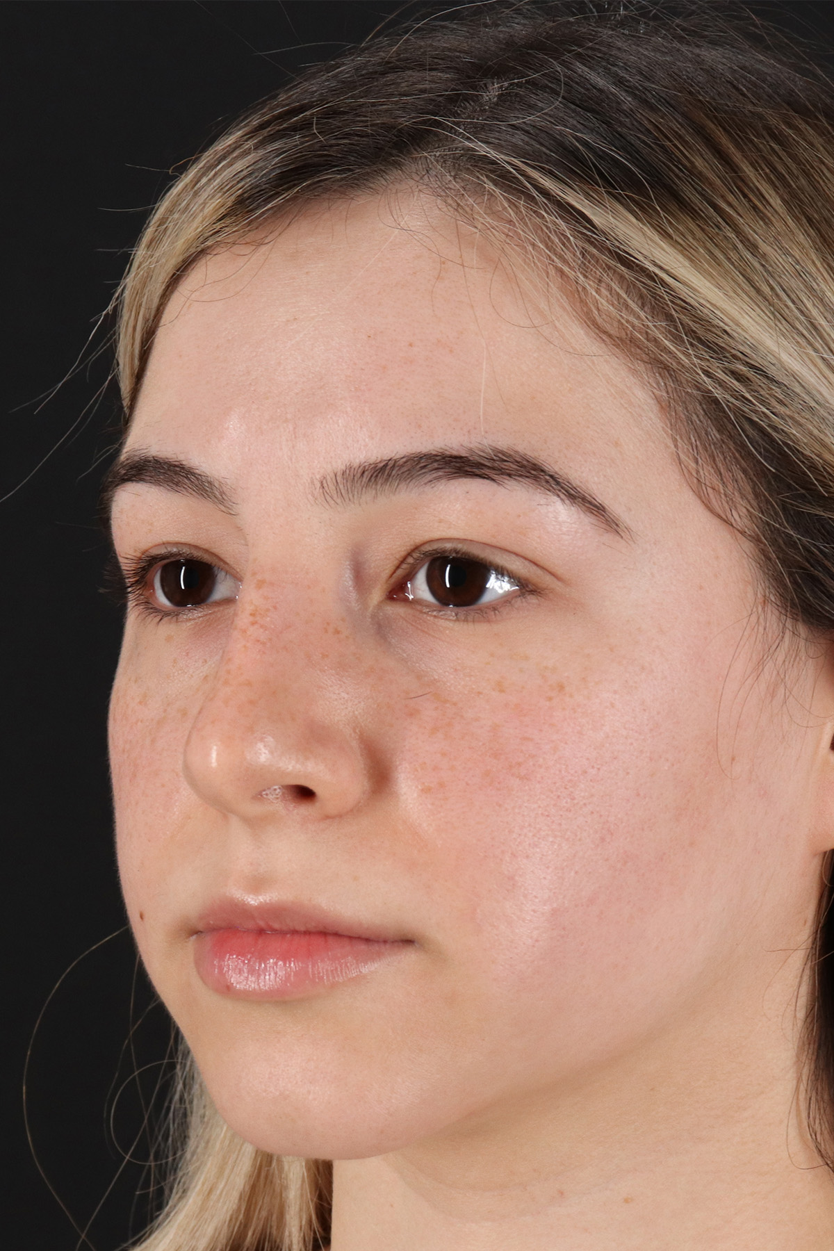 Rhinoplasty Before & After Patient #3247