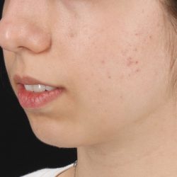 Chin Implant Before & After Patient #1551
