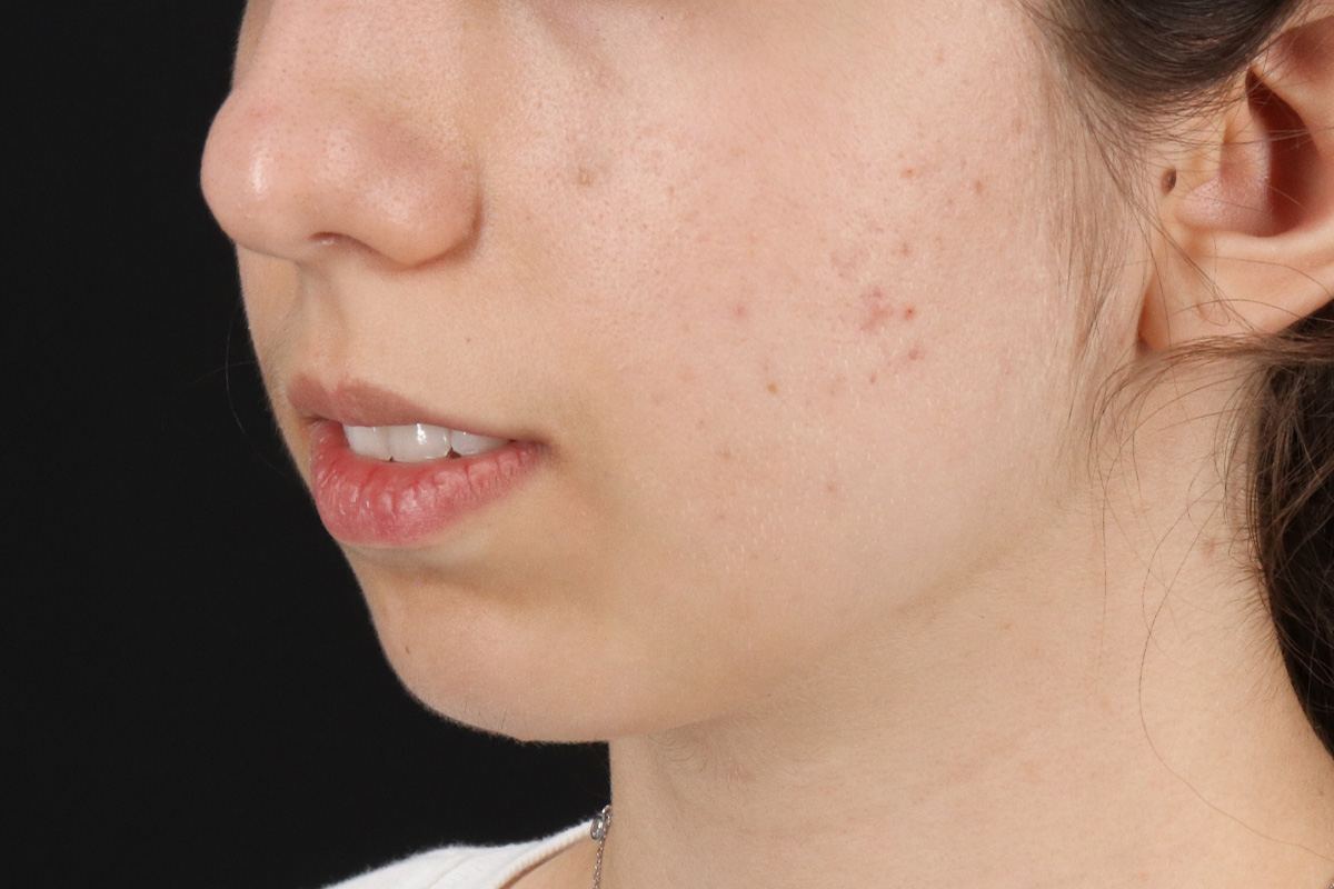 Chin Implant Before & After Patient #1551