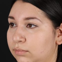 Chin Implant Before & After Patient #1604
