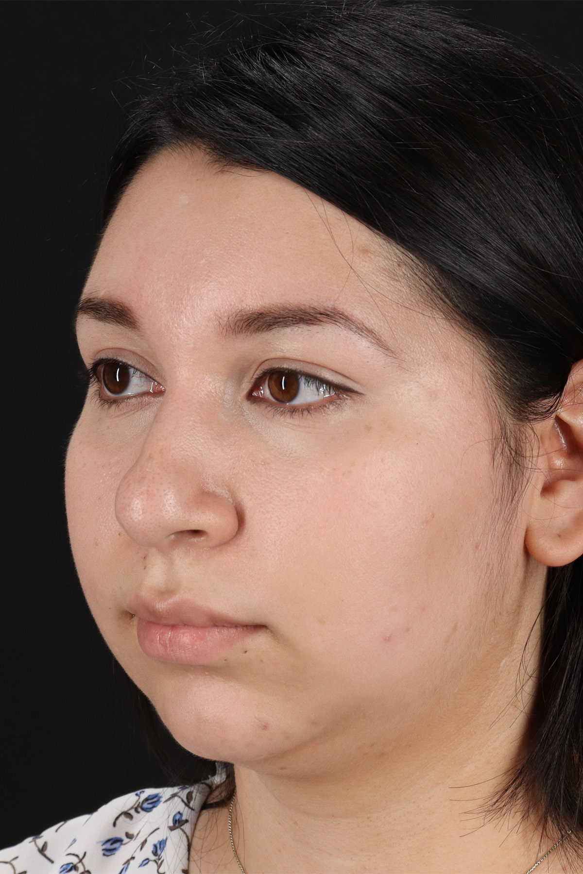 Chin Implant Before & After Patient #1604