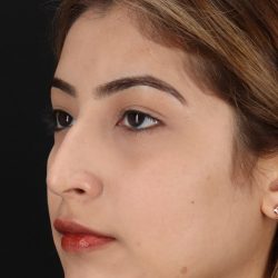 Liquid Rhinoplasty Before & After Patient #2254
