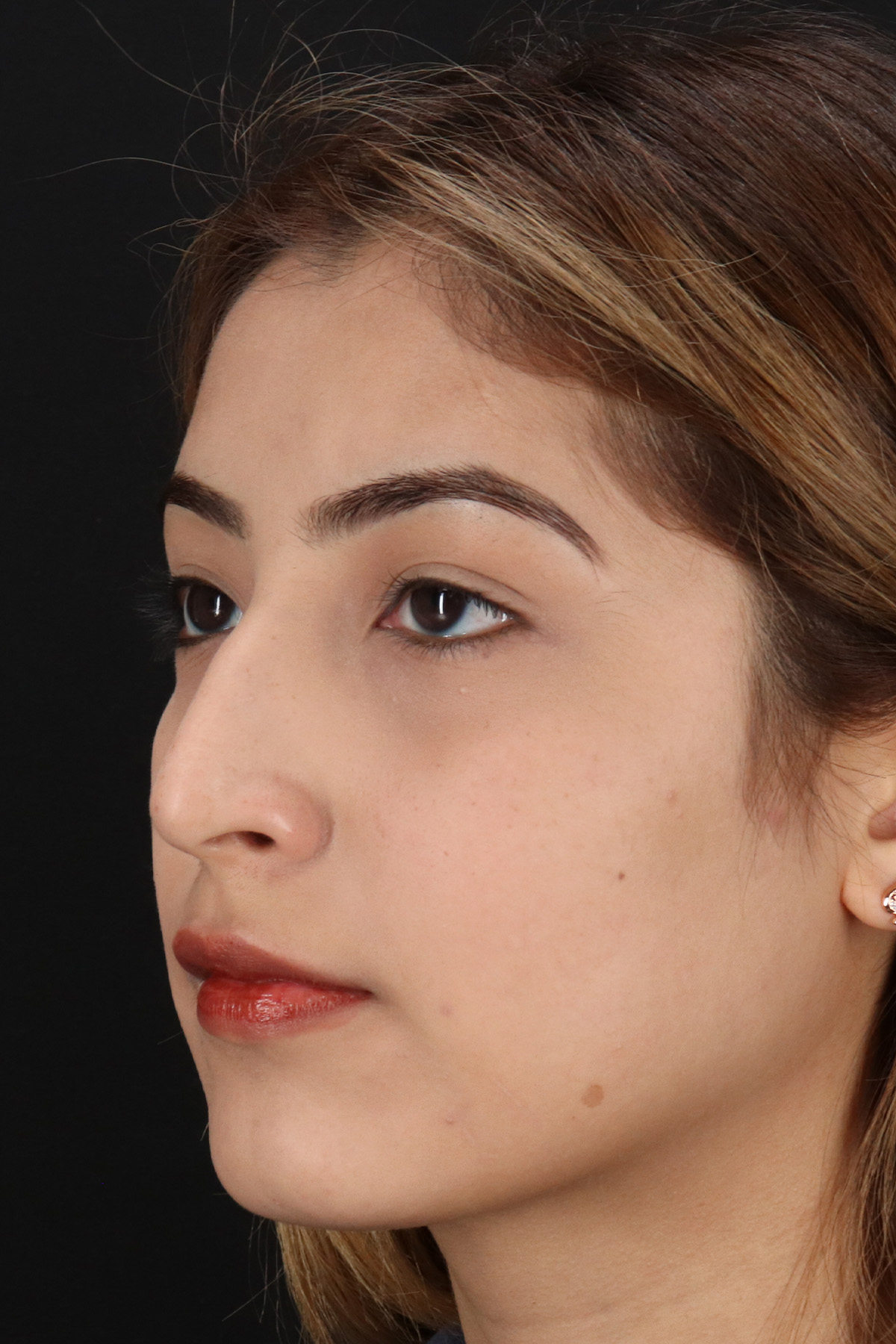 Liquid Rhinoplasty Before & After Patient #2254