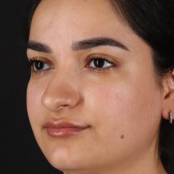 Rhinoplasty Before & After Patient #3071