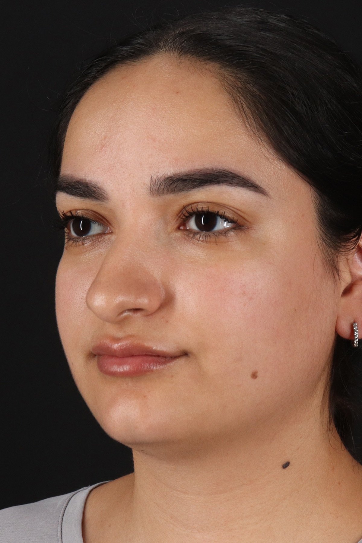 Rhinoplasty Before & After Patient #3071