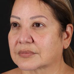Neck Lift Before & After Patient #2593